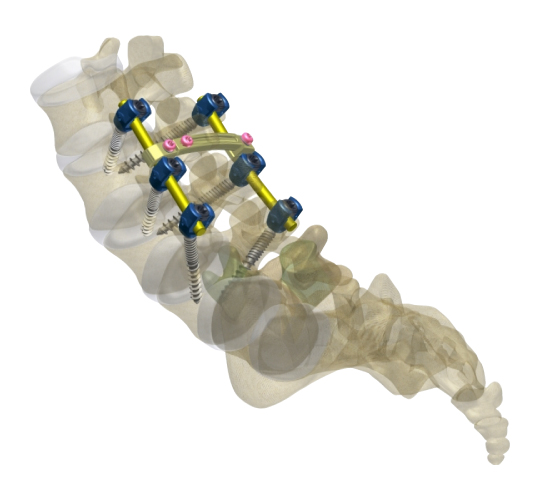 Spinal fixation systems including transpedicular screws and rods