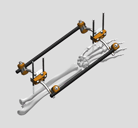 External fixator systems for temporary and definitive bone stabilization