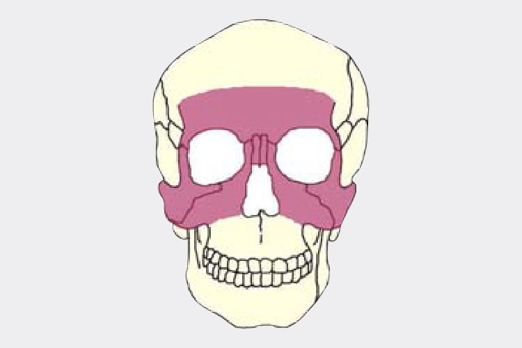 Craniomaxillofacial CMF plating system for facial bone reconstruction