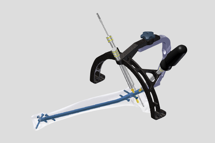 Intramedullary Nail Systems for femur, tibia, and humerus fractures