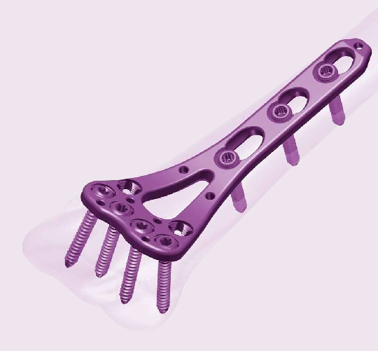 Locking Compression Plate System for orthopedic fracture fixation